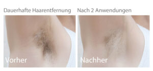 Haarentfernung Ergebnis nach zwei Anwendungen