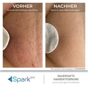 Laser Intimbereich